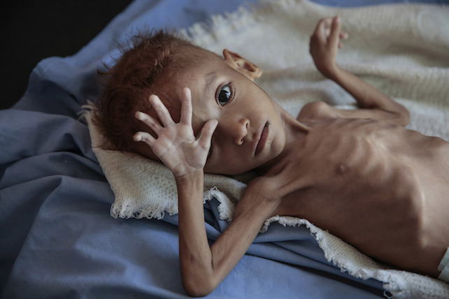 starving children Yemen